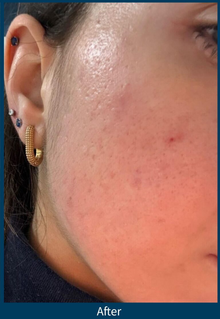 Acne_Female_22_2Treatments_AlchemyMedSpa_Chattanooga_v1