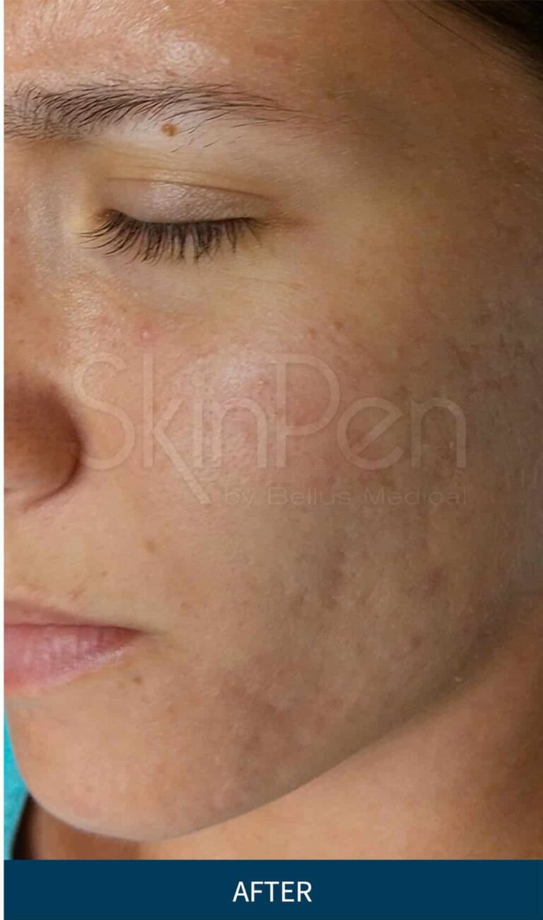 SkinPen_Acne_Melbourne_Female_NA_Before-and-After-Picture