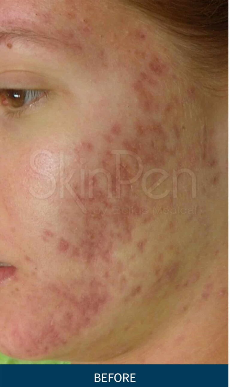 SkinPen_Acne_Melbourne_Female_NA_Before-and-After-Picture - Copy