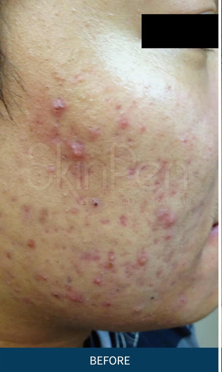 SkinPen_Acne_Orange_Male_27_Before-and-After-Picture - Copy