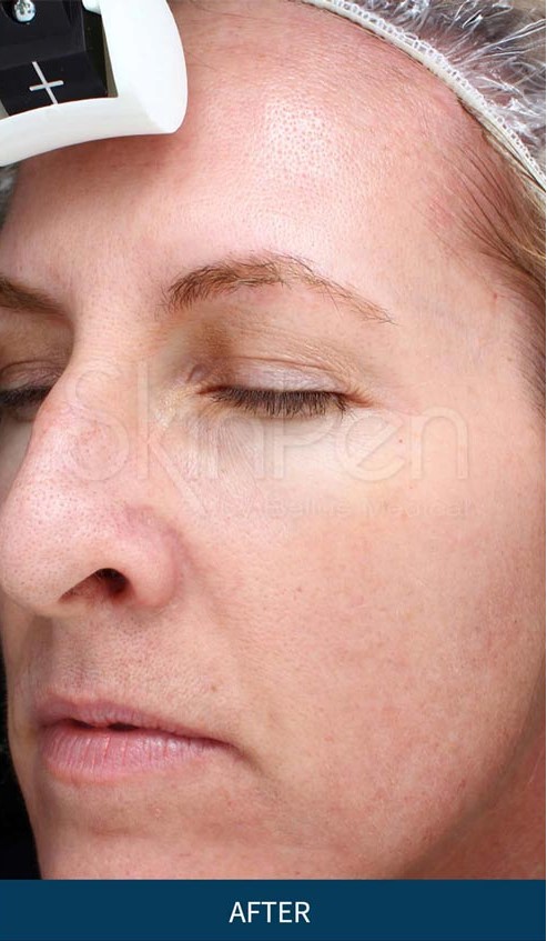 SkinPen_Wrinkles_Orange_Female_45_Before-and-After-Picture