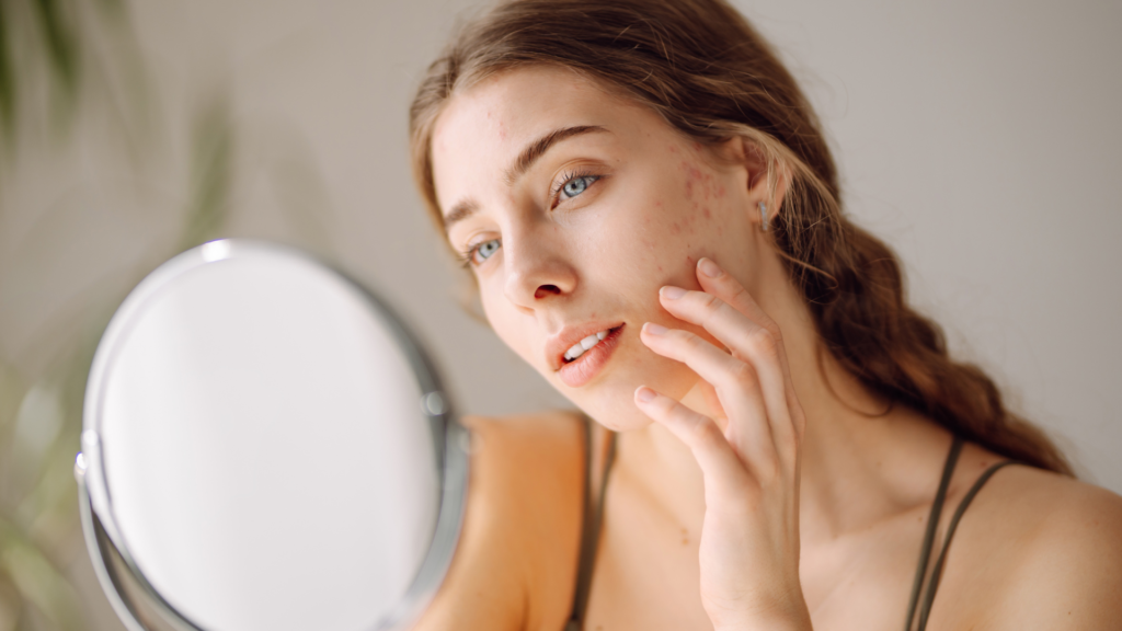 Best Microneedling Treatment for Acne Scars & Wrinkles